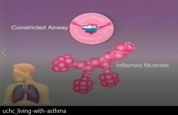 asthma